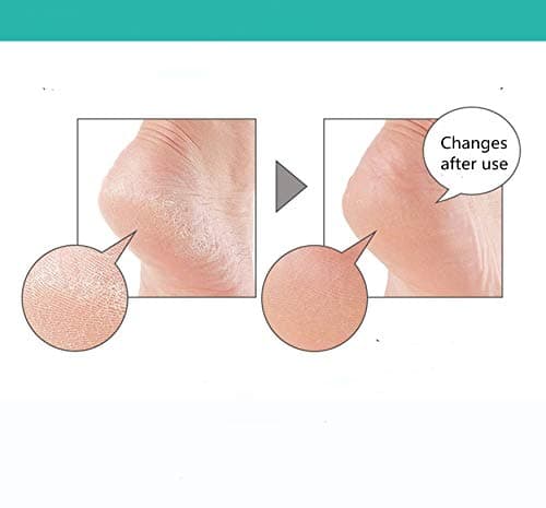 Unisex Silicone Heel Cups for Pain Relief and Cracked Heels