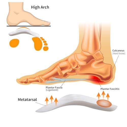 3/4 Arch Support Orthotics Relieve Plantar Fasciitis & Foot Pain (White, Men 6-8.5/Women 8-10.5)