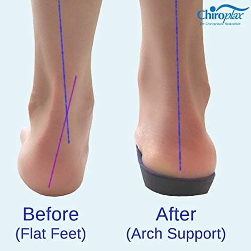 Chiroplax 3/4 Length Orthotic Insoles for Flat Feet and Over-Pronation