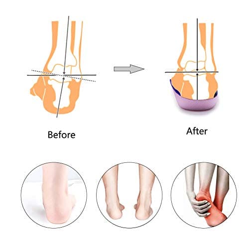 PCSsole XL Arch Supports for High Arches, Plantar Fasciitis, Heel Pain (Men 9-11/Women 10-12)