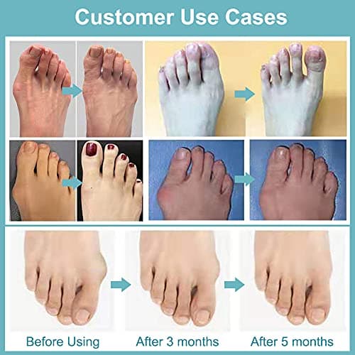 Toe Separators and Bunion Correctors for Women and Men